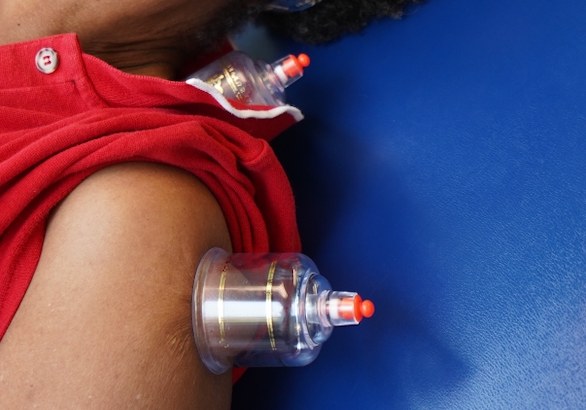Cupping therapy applied to a patient's shoulder